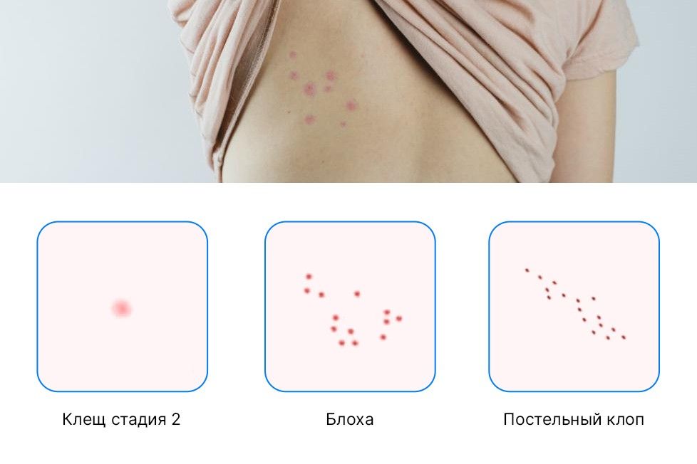 Укус клеша, блохи и постельного клопа